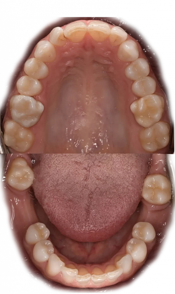 Obturatii dentare (plombe dentare)